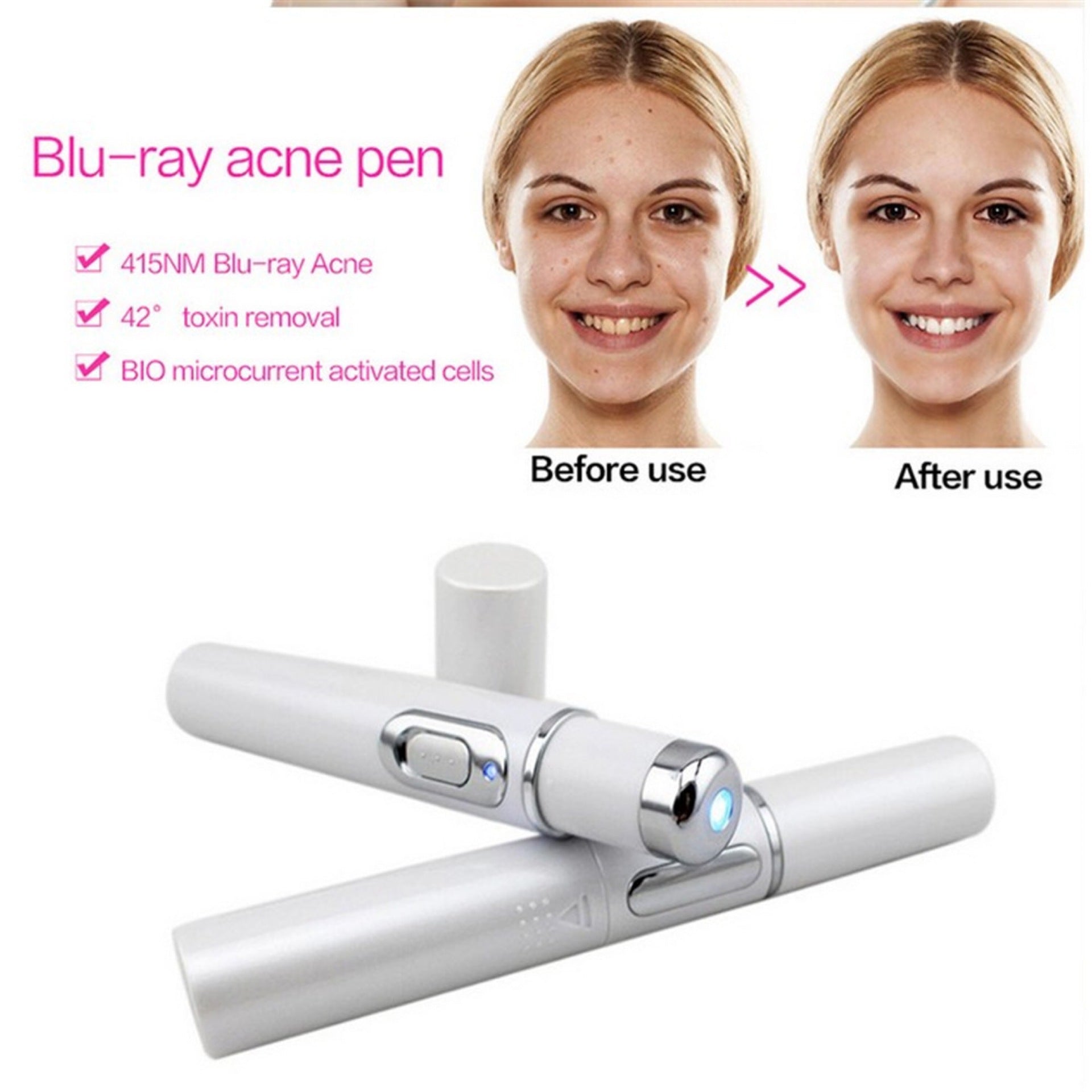 Blue Light Therapy Acne Laser - Urban Mart