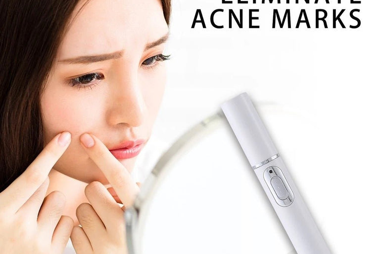 Blue Light Therapy Acne Laser - Urban Mart